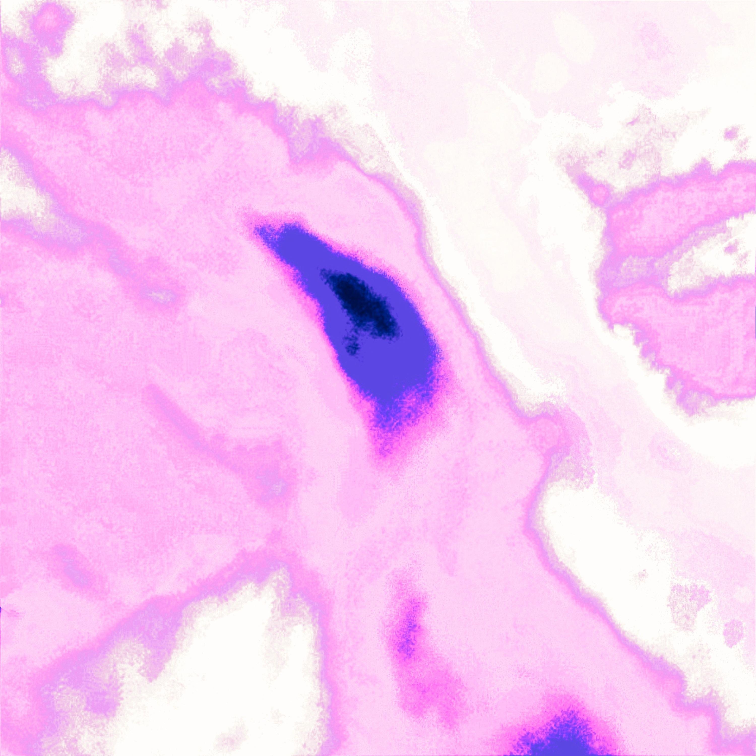 compulsive overeating