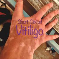 Vitiligo