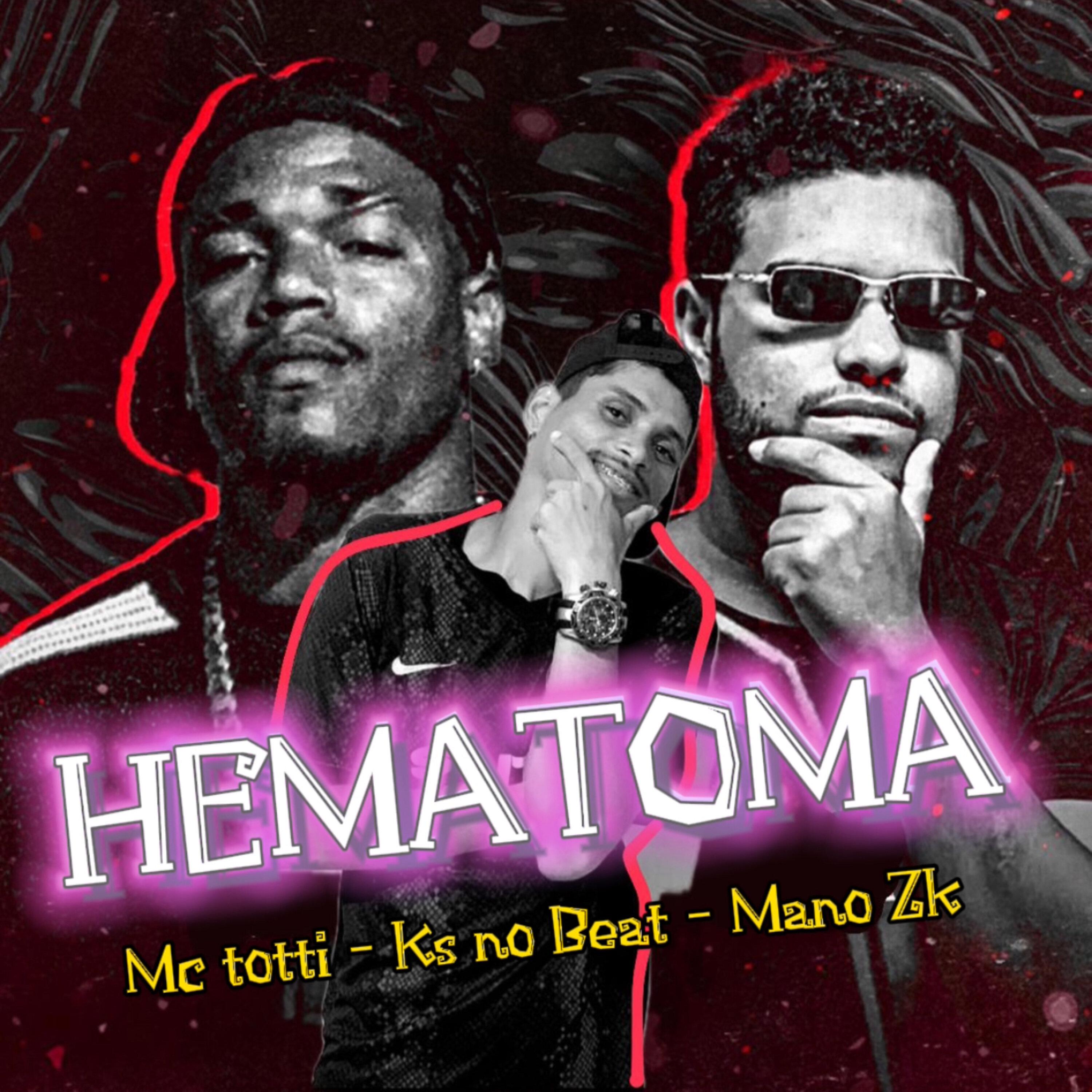 mc totti - Hematoma