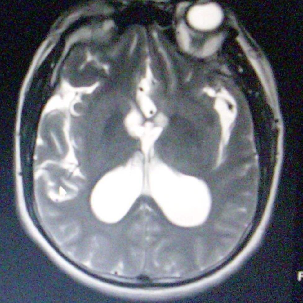 Worms SVCking Cankered Armpit